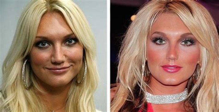 Brooke Hogan Nose Job, Plastic Surgery, Before And After Photos