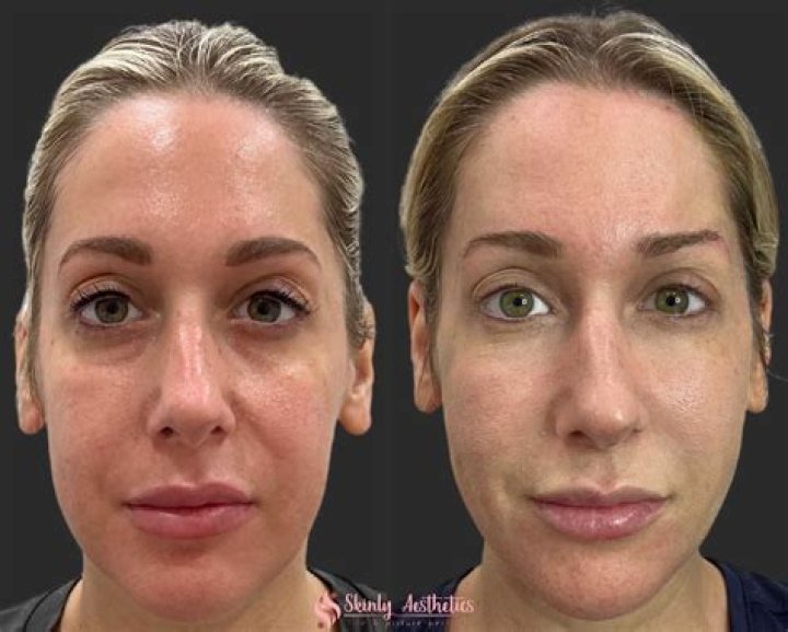 Dane Cook Plastic Surgery With Before And After Photos