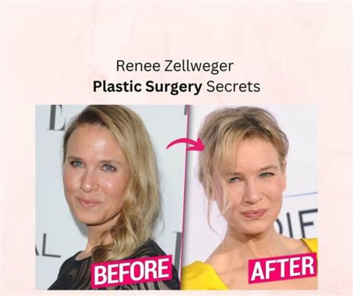What Happens When You Read Between the Lines of Renee Zellweger’s Plastic Surgery Address?